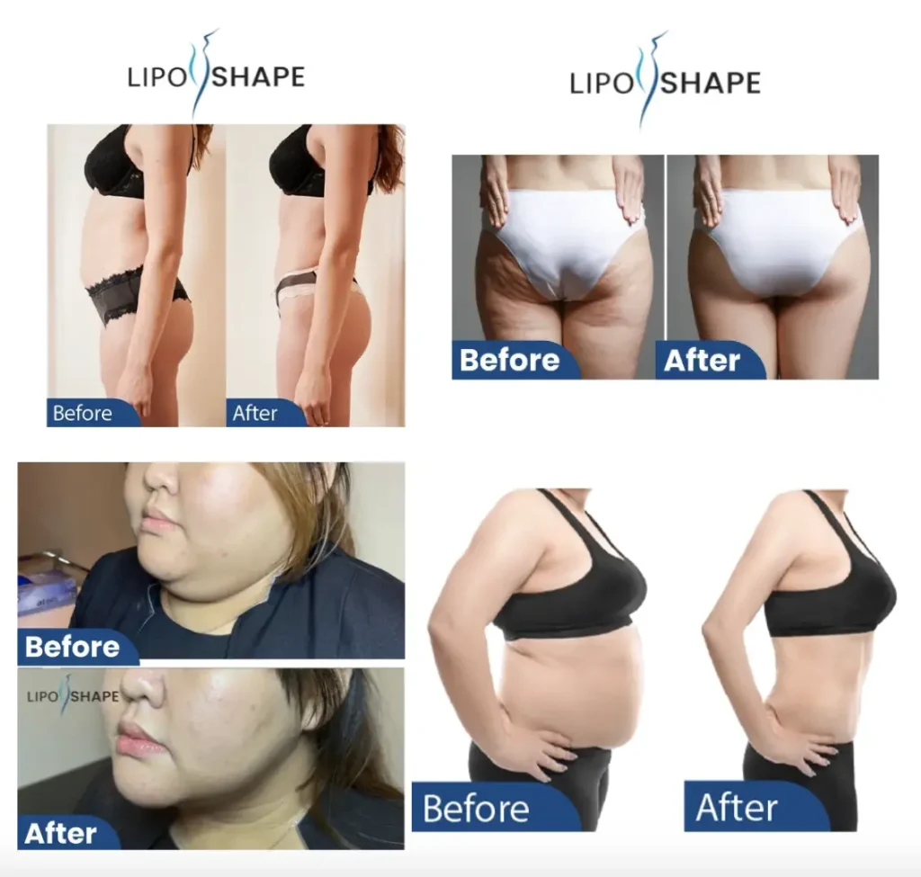Luveen's slimming treatment testimonial, including liposhape, primesculpt and mesotherapy. (before & after)