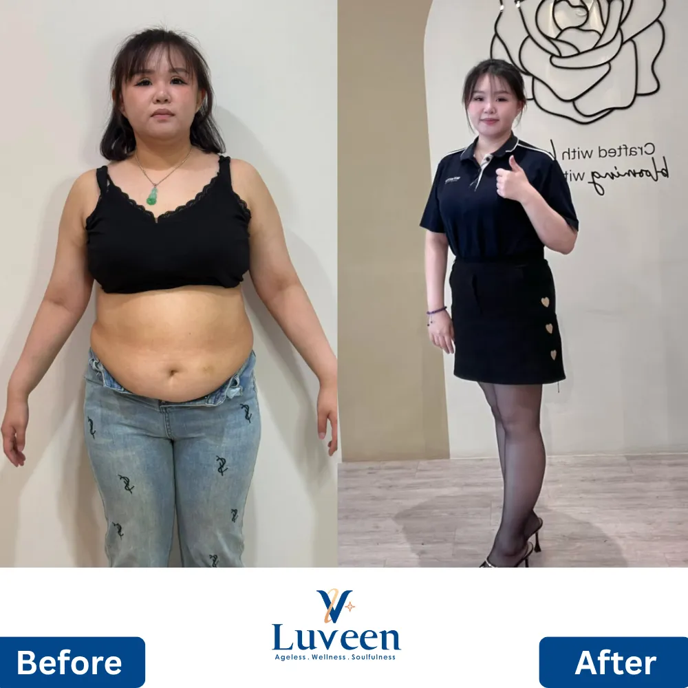 luveen-liposhape-slimming-beforeafter-02